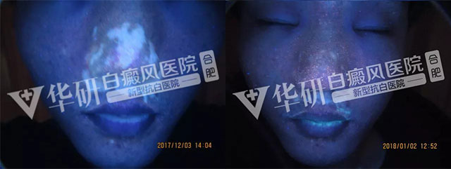 合肥华研白癜风医院在哪?