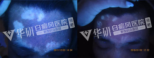 合肥华研白癜风医院的地址在哪?