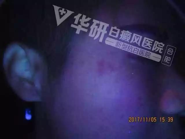 合肥华研白癜风医院费用